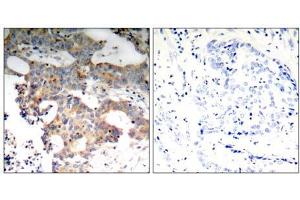 Immunohistochemical analysis of paraffin-embedded human breast carcinoma tissue using IkB-ε (Ab-22) antibody (E021296). (NFKBIE 抗体)