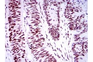 Immunohistochemical analysis of paraffin-embedded colon cancer tissues using TP53BP1 mouse mAb with DAB staining. (TP53BP1 抗体  (AA 574-773))