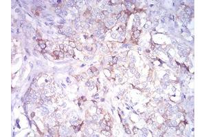 Immunohistochemical analysis of paraffin-embedded bladder cancer tissues using CDH11 mouse mAb with DAB staining.