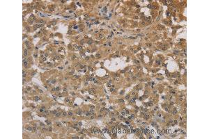 Immunohistochemistry of Human liver cancer using DEGS1 Polyclonal Antibody at dilution of 1:30 (DEGS1 抗体)