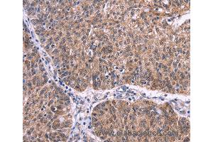 Immunohistochemistry of Human colon cancer using EFNA5 Polyclonal Antibody at dilution of 1:40 (Ephrin A5 抗体)