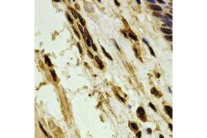 Immunohistochemical analysis of PARN staining in human esophageal cancer formalin fixed paraffin embedded tissue section. (PARN 抗体)