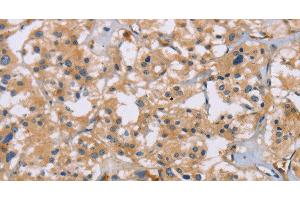 Immunohistochemistry of paraffin-embedded Human thyroid cancer using ACTN4 Polyclonal Antibody at dilution of 1:60 (alpha Actinin 4 抗体)