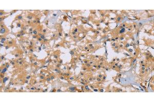 Immunohistochemistry of paraffin-embedded Human thyroid cancer using ACTN4 Polyclonal Antibody at dilution of 1:60