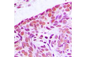 Immunohistochemical analysis of MEKK3 staining in human breast cancer formalin fixed paraffin embedded tissue section. (MAP3K3 抗体  (Center))