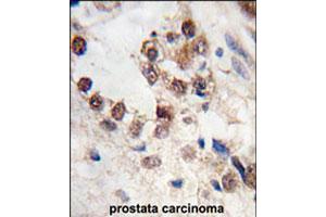 Formalin-fixed and paraffin-embedded human prostate carcinoma tissue reacted with KLF4 polyclonal antibody  , which was peroxidase-conjugated to the secondary antibody, followed by DAB staining. (KLF4 抗体  (N-Term))