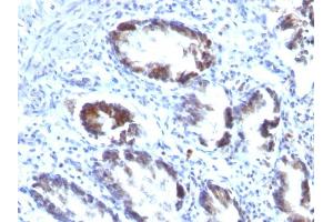 Formalin-fixed, paraffin-embedded human Colon Carcinoma stained with Transgelin Monoclonal Antibody (TAGLN/247) (Transgelin 抗体)