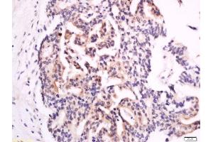 Formalin-fixed and paraffin embedded human colon carcinoma labeled with Anti-XTP4 Polyclonal Antibody, Unconjugated  at 1:300 followed by conjugation to the secondary antibody and DAB staining. (C17orf37 抗体  (AA 10-60))