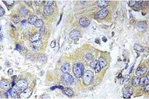 Immunohistochemistry (IHC) analyzes of p-p70 S6 kinase alpha antibody in paraffin-embedded human breast carcinoma tissue. (RPS6KB1 抗体  (pSer434))