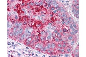 Anti-FZD1 / Frizzled 1 antibody IHC of human Lung, Non-Small Cell Carcinoma. (FZD1 抗体  (N-Term))