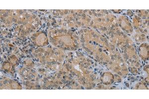 Immunohistochemistry of paraffin-embedded Human thyroid cancer tissue using CLEC1A Polyclonal Antibody at dilution 1:40 (CLEC1A 抗体)