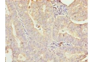 Immunohistochemistry of paraffin-embedded human endometrial cancer using ABIN7160680 at dilution of 1:100 (GALNT7 抗体  (AA 201-500))