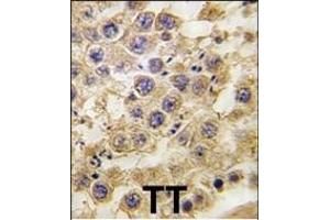 Formalin-fixed and paraffin-embedded human testis tissue reacted with NANOS2 antibody (C-term) (ABIN389197 and ABIN2839360) , which was peroxidase-conjugated to the secondary antibody, followed by DAB staining. (NANOS2 抗体  (C-Term))