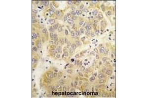 Formalin-fixed and paraffin-embedded human hepatocarcinoma tissue reacted with the VARS antibody (N-term)  , which was peroxidase-conjugated to the secondary antibody, followed by DAB staining. (VARS 抗体  (N-Term))