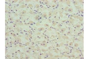 Immunohistochemistry of paraffin-embedded human gastric cancer using ABIN7146581 at dilution of 1:100 (Calsequestrin 抗体  (AA 127-396))