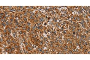 Immunohistochemistry of paraffin-embedded Human lung cancer using PLEKHG6 Polyclonal Antibody at dilution of 1:45 (PLEKHG6 抗体)