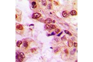 Immunohistochemical analysis of ASC-1 staining in human lung cancer formalin fixed paraffin embedded tissue section. (TRIP4 抗体)