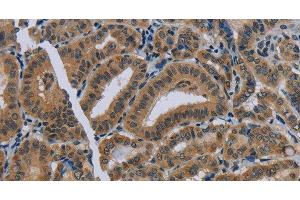 Immunohistochemistry of paraffin-embedded Human thyroid cancer using NAT10 Polyclonal Antibody at dilution of 1:40 (NAT10 抗体)