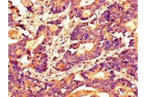 Immunohistochemistry of paraffin-embedded human colon cancer using ABIN7155305 at dilution of 1:100 (HDAC1 抗体  (AA 207-412))