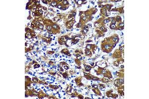 Immunohistochemistry of paraffin-embedded Human liver cancer using CTNN Rabbit pAb (ABIN7266136) at dilution of 1:100 (40x lens). (CTNNA3 抗体  (AA 1-240))