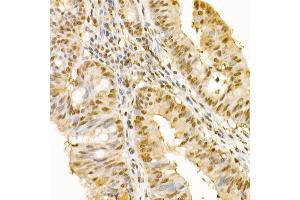 Immunohistochemistry of paraffin-embedded human colon carcinoma using SS18 Rabbit pAb (ABIN6133185, ABIN6148473, ABIN6148474 and ABIN6222754) at dilution of 1:100 (40x lens). (SS18 抗体  (AA 1-240))