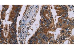 Immunohistochemistry of paraffin-embedded Human colon cancer tissue using CLDND1 Polyclonal Antibody at dilution 1:40 (CLDND1 抗体)