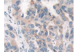 Detection of PAR4 in Human Breast cancer Tissue using Polyclonal Antibody to Protease Activated Receptor 4 (PAR4) (F2RL3 抗体  (AA 48-385))