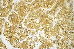 Immunohistochemistry was performed on paraffin-embedded human hepatocarcinoma using Glutamate-ammonia ligase antibody (ABIN7798741), 1:200).