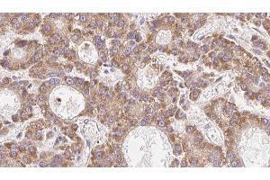 ABIN6279253 at 1/100 staining Human liver cancer tissue by IHC-P. (CPD 抗体  (N-Term))