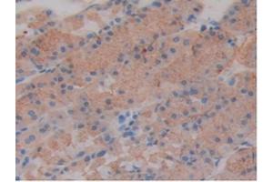IHC-P analysis of Mouse Stomach Cancer Tissue, with DAB staining. (SLIT1 抗体  (AA 603-773))
