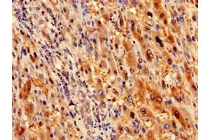 Immunohistochemistry analysis of human liver cancer using ABIN7168095 at dilution of 1:100 (Ribokinase 抗体  (AA 2-322))