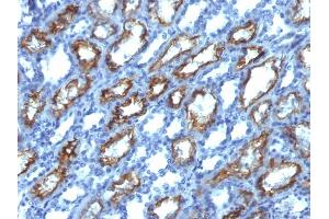 Formalin-fixed, paraffin-embedded human Renal Cell Carcinoma stained with Interferon gamma Mouse Monoclonal Antibody (IFNG/466). (Interferon gamma 抗体)