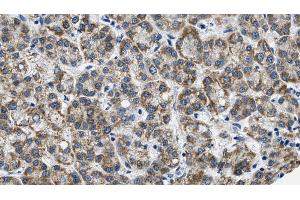 ABIN6269004 at 1/100 staining Human liver cancer tissue by IHC-P. (Metabotropic Glutamate Receptor 3 抗体  (C-Term))