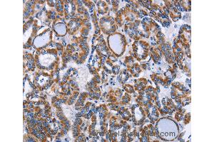 Immunohistochemistry of Human lung cancer using INTS10 Polyclonal Antibody at dilution of 1:50 (INTS10 抗体)