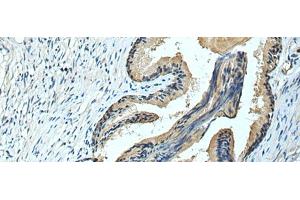 Immunohistochemistry of paraffin-embedded Human prost ate cancer tissue using FCRLA Polyclonal Antibody at dilution of 1:90(x200) (FCRLA 抗体)