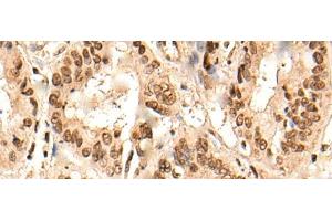 Immunohistochemistry of paraffin-embedded Human liver cancer tissue using URI1 Polyclonal Antibody at dilution of 1:45(x200) (URI1 抗体)