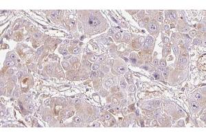 ABIN6272716 at 1/100 staining Human liver cancer tissue by IHC-P. (OR1K1 抗体)