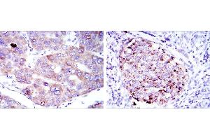 Immunohistochemical analysis of paraffin-embedded liver cancer tissues (left) and kidney cancer tissues (right) using EEF2 mouse mAb with DAB staining.