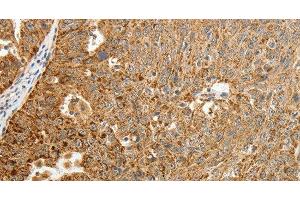Immunohistochemistry of paraffin-embedded Human ovarian cancer tissue using TFF2 Polyclonal Antibody at dilution 1:40 (Trefoil Factor 2 抗体)