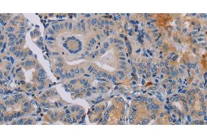 Immunohistochemistry of paraffin-embedded Human thyroid cancer tissue using PYY Polyclonal Antibody at dilution 1:30 (Peptide YY 抗体)