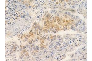 ABIN6261413 and ABIN6266532 at 1/100 staining human lung squamous cell carcinoma by IHC-P.
