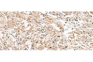 Immunohistochemistry of paraffin-embedded Human liver cancer tissue using FGR Polyclonal Antibody at dilution of 1:35(x200)