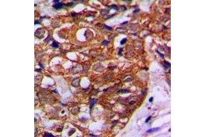Immunohistochemical analysis of MVK staining in human breast cancer formalin fixed paraffin embedded tissue section. (MVK 抗体)