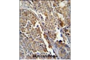 ALDH3A2 Monoclonal Antibody (Ascites) ABIN659009 immunohistochemistry analysis in formalin fixed and paraffin embedded human skin carcinoma followed by peroxidase conjμgation of the secondary antibody and DAB staining.