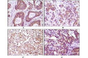 Immunohistochemical analysis of paraffin-embedded human colon carcinoma(A), breast carcinoma(B), kidney cell carcinoma(C), bladder carcinoma tumor(D), showing membrane and cytoplasmic localization using IKBKB mouse mAb with DAB staining. (IKBKB 抗体)