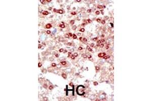 Formalin-fixed and paraffin-embedded human cancer tissue reacted with the primary antibody, which was peroxidase-conjugated to the secondary antibody, followed by DAB staining. (SUMO2/3 抗体  (C-Term))