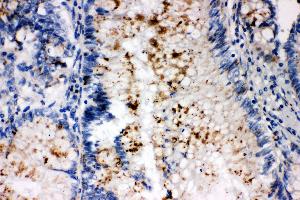 Anti-SSX2 antibody, IHC(P) IHC(P): Human Intestinal Cancer Tissue (SSX2 抗体  (C-Term))
