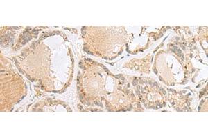 Immunohistochemistry of paraffin-embedded Human thyroid cancer tissue using CNPY3 Polyclonal Antibody at dilution of 1:55(x200) (TNRC5 抗体)