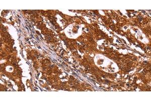 Immunohistochemistry of paraffin-embedded Human gastric cancer using ABI1 Polyclonal Antibody at dilution of 1:40 (ABI1 抗体)