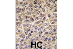 Formalin-fixed and paraffin-embedded human hepatocarcinoma tissue reacted with ILK Antibody (S246) , which was peroxidase-conjugated to the secondary antibody, followed by DAB staining. (ILK 抗体  (AA 225-253))